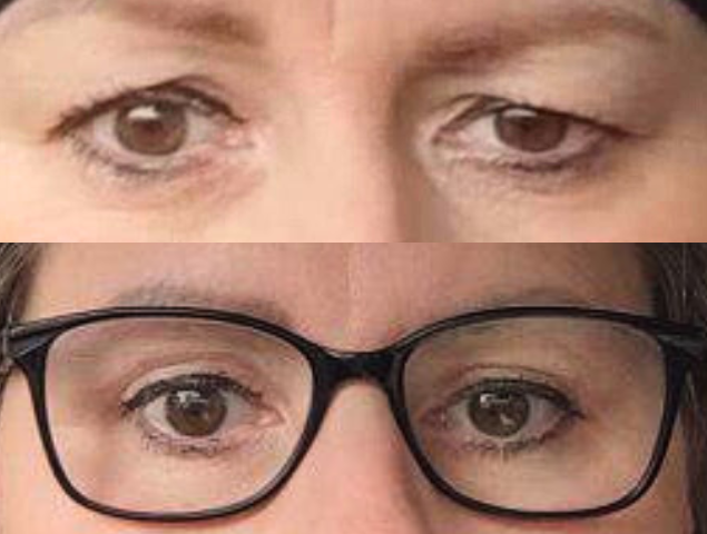 Augenlidstraffung Foto