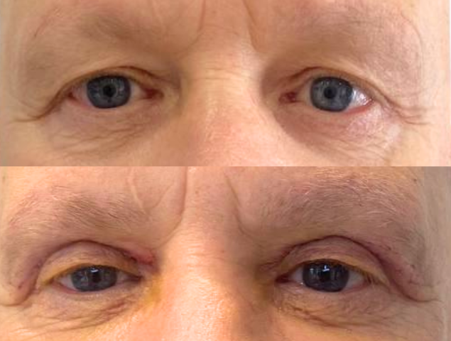 Augenlidstraffung Foto