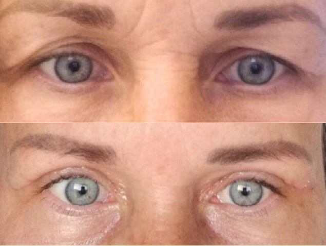 Augenlidstraffung Foto
